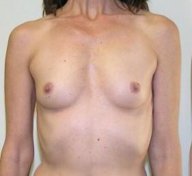 Breast Augmentation Before and After Pictures Jupiter, FL