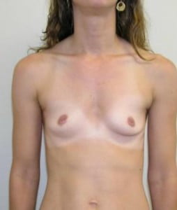 Breast Augmentation Before and After Pictures Jupiter, FL