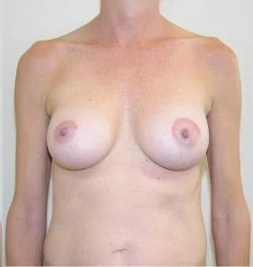 Breast Augmentation Before and After Pictures Jupiter, FL