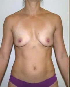 Breast Augmentation Before and After Pictures Jupiter, FL