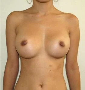 Breast Augmentation Before and After Pictures Jupiter, FL