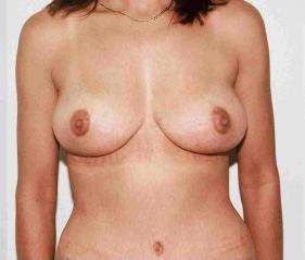 Breast Lift Before and After Pictures Jupiter, FL
