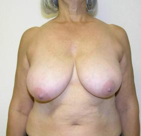 Breast Reduction Before and After Pictures Jupiter, FL