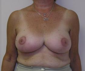 Breast Reduction Before and After Pictures Jupiter, FL