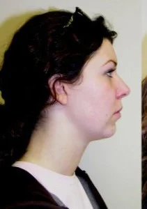 Chin Implant Before and After Pictures Jupiter, FL