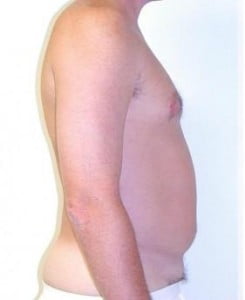 Liposuction Before and After Pictures Jupiter, FL