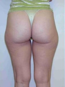 Liposuction Before and After Pictures Jupiter, FL