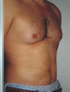 Liposuction Before and After Pictures Jupiter, FL