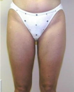 Liposuction Before and After Pictures Jupiter, FL