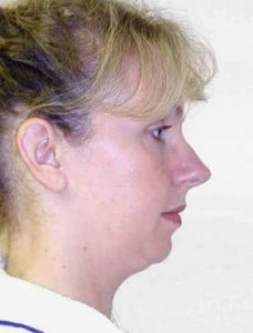 Rhinoplasty Before and After Pictures Jupiter, FL