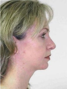 Rhinoplasty Before and After Pictures Jupiter, FL