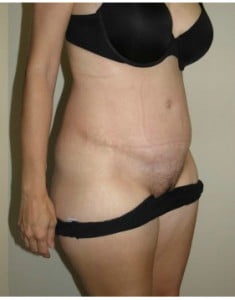 Tummy Tuck Before and After Pictures Jupiter, FL