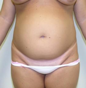 Tummy Tuck Before and After Pictures Jupiter, FL